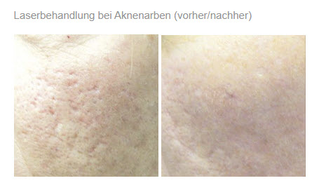 Laserbehandlung2